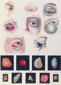 Beschrijving van aangeboren oogafwijkingen, uit Klinische Darstellungen der Krankheiten und Blidungsfehler des Mesnschlichen Auges, door Friedrich August von Ammon (1799-1861) 1838
