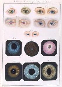 Beschrijving van aangeboren oogafwijkingen, uit Klinische Darstellungen der Krankheiten und Blidungsfehler des Menschlichen Auges, door Friedrich August von Ammon, 1838