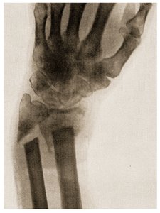 Röntgenfoto van een Gebroken Pols, ca. 1890 door German School