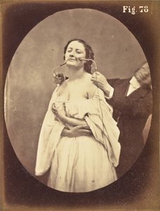 Fig. 78 door Guillaume Benjamin Duchenne