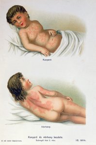 Mazelen en roodvonk, uit een familie medisch boek, c.1900 door Hungarian School