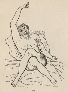 Hysterische epilepsie, aanval, vervormingen, fig. 1 uit 