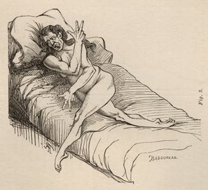 Hysterische epilepsie, aanval, vervormingen, fig. 3 uit 