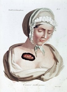 Anthracine kanker - Alibert, B.N.