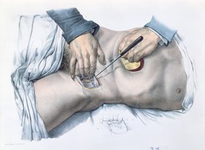 Het afbinden van een slagader, plaat uit 