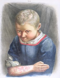 Favus, uit een boek door Daniel Cornelius Danielssen, 1892 door Norwegian School