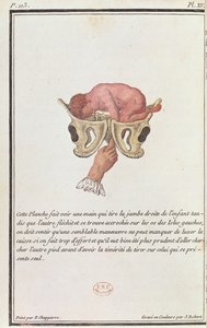 Dwarsdoorsnede diagram van een baby uit de baarmoeder getrokken door de arm, uit een boek van Madame Angelique Le Boursier du Coudray gegraveerd door J. Robert, 1783 door P. Chapparre