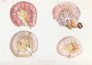 Het externe oppervlak van de darmen geïnfecteerd met cholera, uit Anatomie Pathologique du Cholera Morbus, door Nikolai Ivanovich Pirogov, gepubliceerd in St. Petersburg, 1849 door Russian School