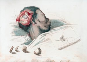 Zicht op wond in schedel na trepanatie en verwijdering van verbrijzeld botstuk linksonder, 1821 door Thomas Landseer