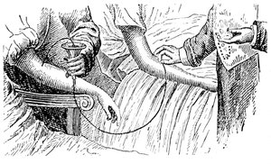 Bloedtransfusie, ca. 1880