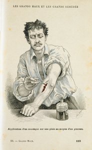Een wond schilderen met een antiseptische oplossing, ca. 1890 door Unbekannt