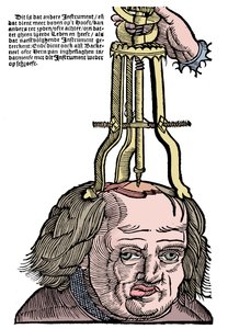 Trepanatie, 1593 door Unbekannt