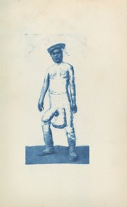 Elephantiasis door Unknown 19th Century