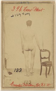 Breuk van het bovenste derde deel van het dijbeen. Erastus Worthen, Corp Co. B. 2nd Vermont Vols. 25 jaar oud - Woonplaats Stockbridge VT.