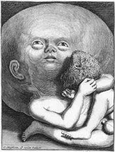 Monster: Kind hydrocephalus antropologie - gravure, eind 18e eeuw