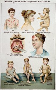 Plaat die de verschillende vormen van syfilitische ziekten en de gevaren van vaccinatie illustreert - in Bilz natuurlijke geneeskunde, eind 19e eeuw door Unknown artist