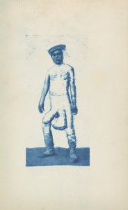 Elefantiasis,ca. 1870 (foto)