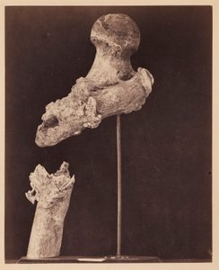 Luitenant Goodwin, overleden, eenzijdige schotbreuk van het bovenste derde deel van de rechter dijbeen, zeven maanden na de verwonding, uit de fotocatalogus van de chirurgische afdeling