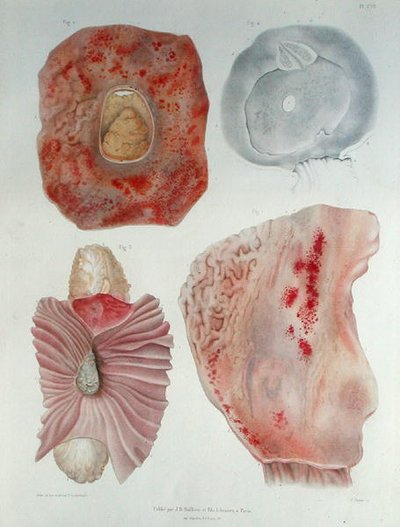 Organen geïnfecteerd met cholera, uit 