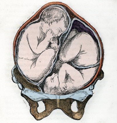 Weergave van de goede positie van twee foetussen tijdens een tweelingzwangerschap Gravure uit 