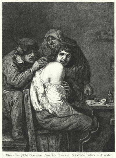 De Rugoperatie door Adriaen (after) Brouwer