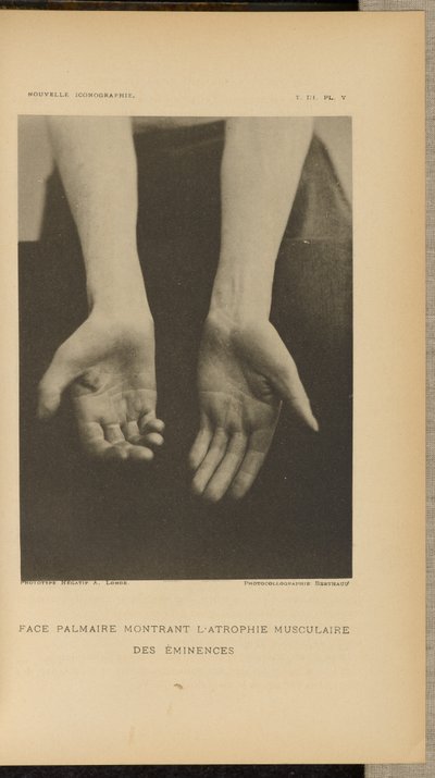 Palmar oppervlak met spieratrofie van de eminences door Albert Londe