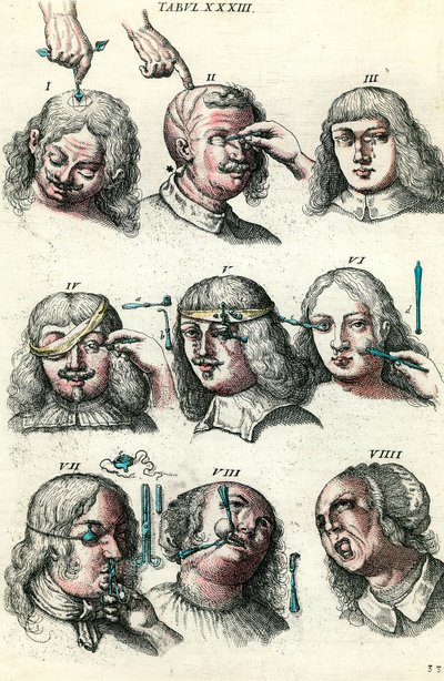 Chirurgie in de 18e eeuw: Trepanatie en operatie van het oog en gezicht. Gravure in 