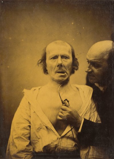 Deze samentrekking van m. platysma alleen mist expressie, 1854-1856, gedrukt 1862 door Duchenne de Boulogne