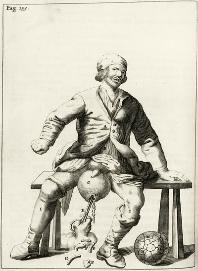 Aftappen van vocht uit een hydrocele van het scrotum, uit Exercitationes Practicae circa Medendi Methodum door Frederik Dekkers, 1694 door Dutch School