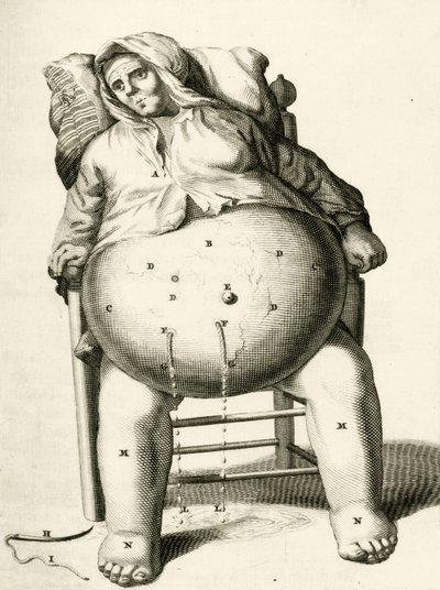 Aftappen van vocht uit een abces, uit Exercitationes Practicae circa Medendi Methodum door Frederik Dekkers, 1694 door Dutch School