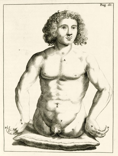 Voorbeeld van aangeboren geboorteafwijkingen, uit Exercitationes Practicae circa Medendi Methodum door Frederik Dekkers, 1694 door Dutch School
