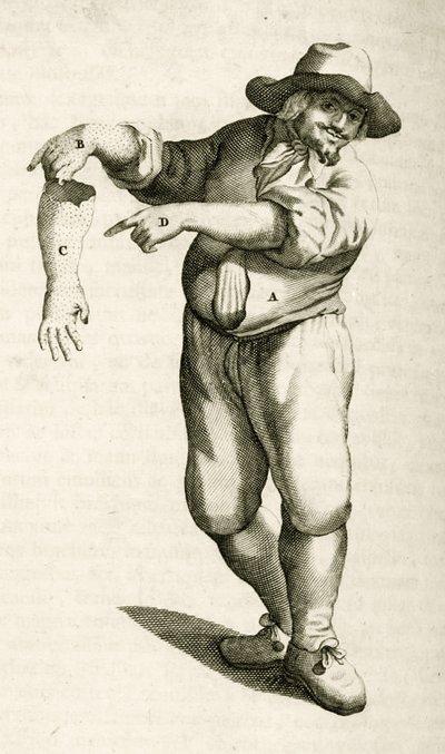 Verwijderen van dode huid met puisten, uit Exercitationes Practicae circa Medendi Methodum door Frederik Dekkers, 1694 door Dutch School