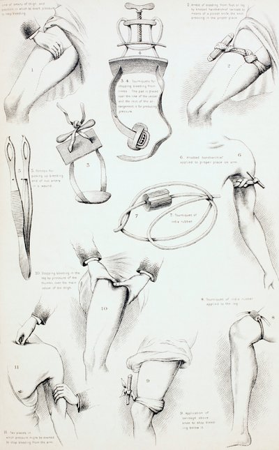 Methoden om Bloeden te Stoppen, ca. 1890 door English School