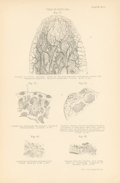 Darmvlokken bij cholera (kleurenlitho) door English School