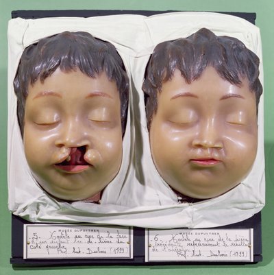 Model dat een kinderlijk gezicht toont voor en na een operatie om een hazenlip te corrigeren uitgevoerd door Antoine Dubois (1756-1837) in 1799 (was) door French School