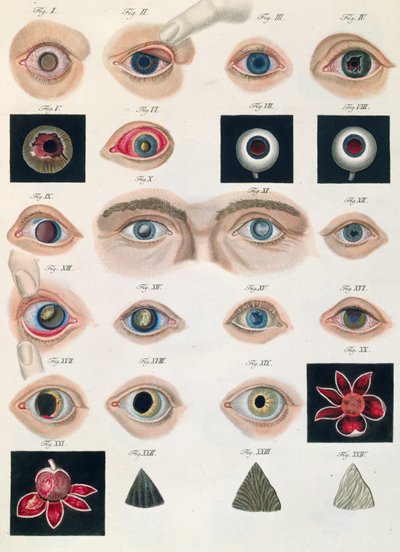 Beschrijving van aangeboren oogafwijkingen, uit Klinische Darstellungen der Krankheiten und Blidungsfehler des Mesnschlichen Auges, door Friedrich August von Ammon (1799-1861) 1838 door German School