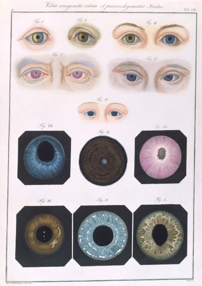 Beschrijving van aangeboren oogafwijkingen, uit Klinische Darstellungen der Krankheiten und Blidungsfehler des Menschlichen Auges, door Friedrich August von Ammon, 1838 door German School