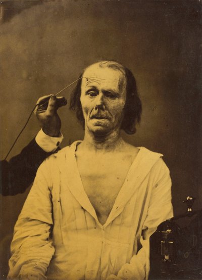 Een ontspannen gezicht (links); Diepe aandacht (rechts),1854-1856, gedrukt 1862 (foto) door Guillaume-Benjamin-Armand Duchenne de Boulogne