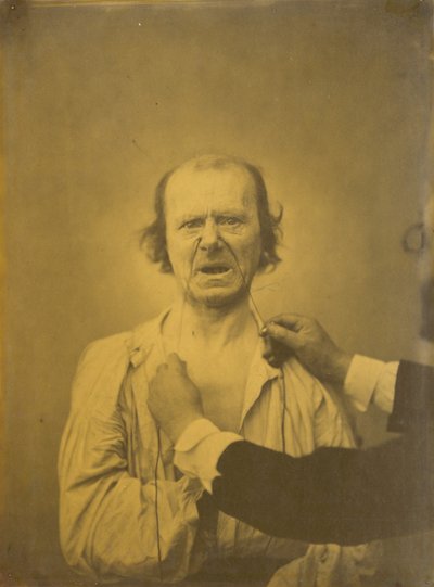 Ontevredenheid, slechte humor,1854-1856, gedrukt 1862 (foto) door Guillaume-Benjamin-Armand Duchenne de Boulogne