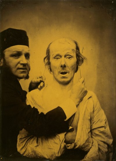 Verrassing,1854-1855, gedrukt 1862 (foto) door Guillaume-Benjamin-Armand Duchenne de Boulogne