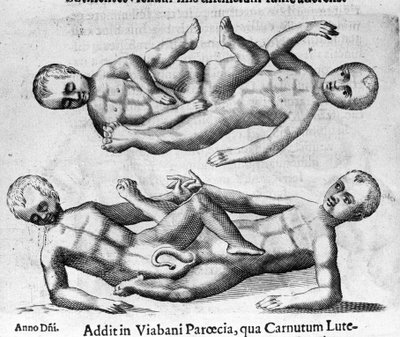 Verschillende soorten menselijke monsters: Siamese kinderen verbonden door het bekken. Gravure uit 