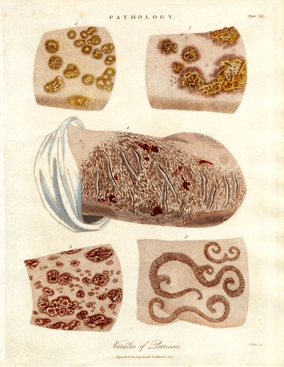 Pathologische huidveranderingen: Verscheidenheden van psoriasis door John Pass