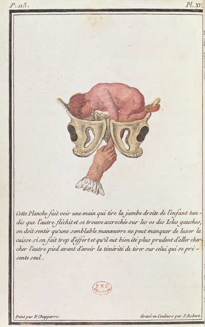 Dwarsdoorsnede diagram van een baby uit de baarmoeder getrokken door de arm, uit een boek van Madame Angelique Le Boursier du Coudray gegraveerd door J. Robert, 1783 door P. Chapparre