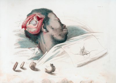 Zicht op wond in schedel na trepanatie en verwijdering van verbrijzeld botstuk linksonder, 1821 door Thomas Landseer