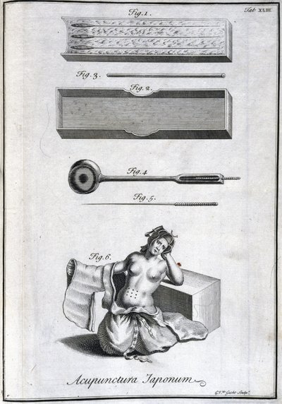 Alternatieve geneeskunde: plaat met acupunctuurnaalden en hun toepassing, gravure uit 