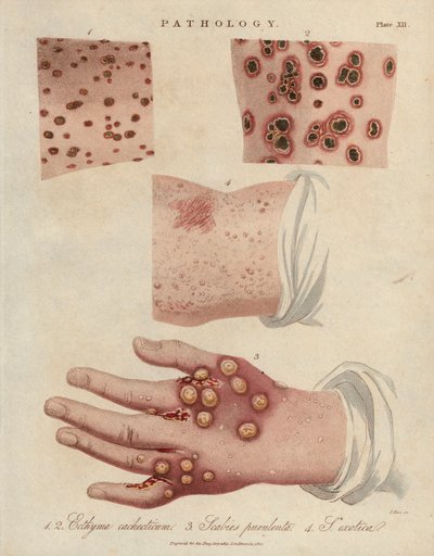 Huidzweer, etterige schurft en schurft veroorzaakt door een scabiei sarcoptische mijt - Lithografie door John Pass, gepubliceerd in Encyclopedia Londinensis door John Wilkes, J.Adlard editie, Londen door Unbekannter Künstler