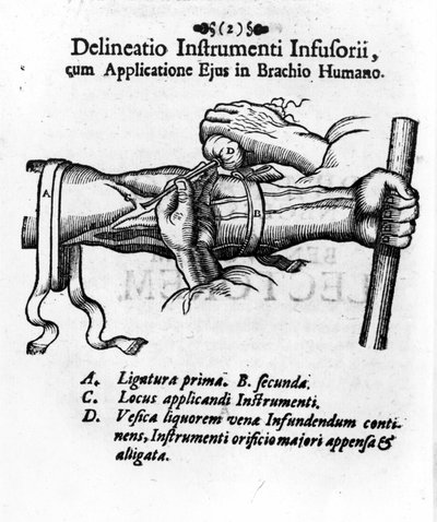Intraveneuze injectie met een klysma blaas. door J. D. Mayor, 