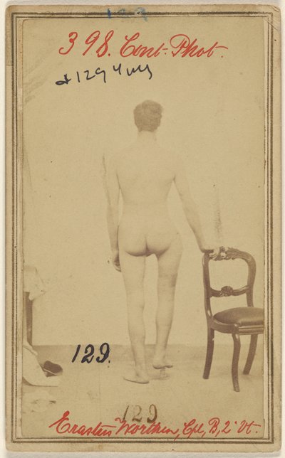 Breuk van het bovenste derde deel van het dijbeen. Erastus Worthen, Corp Co. B. 2nd Vermont Vols. 25 jaar oud - Woonplaats Stockbridge VT. door Unknown artist