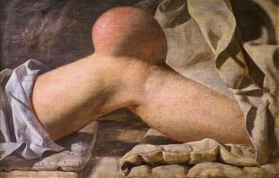 Een zwelling in de Regio Patellaris [knie]. door Wilhelm Ferdinand Bendz