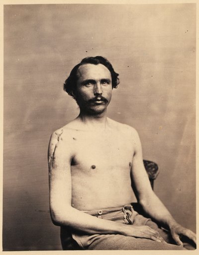 Soldaat Adolph Zirsse, Geslaagde intermediaire excisie van de kop en twee en een halve centimeter van de schacht van de rechter Humerus, uit de fotocatalogus van de chirurgische afdeling door William Bell